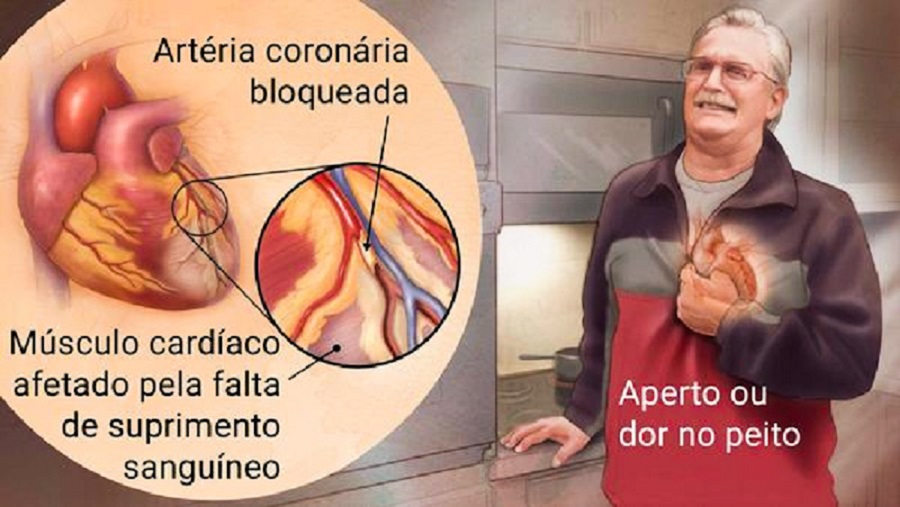 INFARTO: SINAIS QUE O CORPO DÁ SEMANAS ANTES DE ACONTECER - Blog